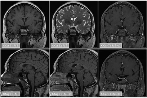 pituitary stalk interruption syndrome|Pituitary Stalk Interruption Syndrome from Infancy to Adulthood .